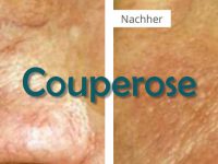Couperose Behandlung