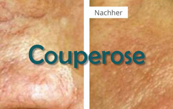 Couperose Behandlung